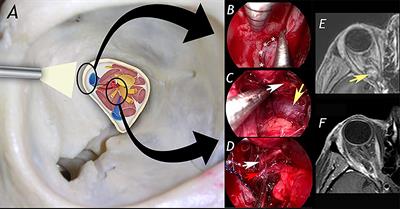 Endoscopic-assisted transorbital surgery: Where do we stand on the scott’s parabola? personal considerations after a 10-year experience